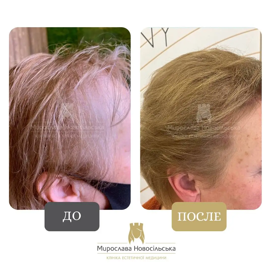 Лечение алопеции у женщин, фото 4