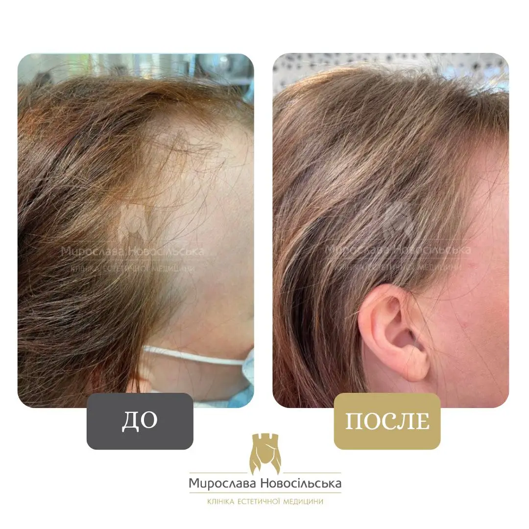 Лечение алопеции у женщин, фото 3