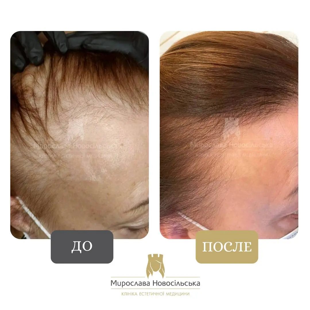 Лечение алопеции у женщин, фото 11