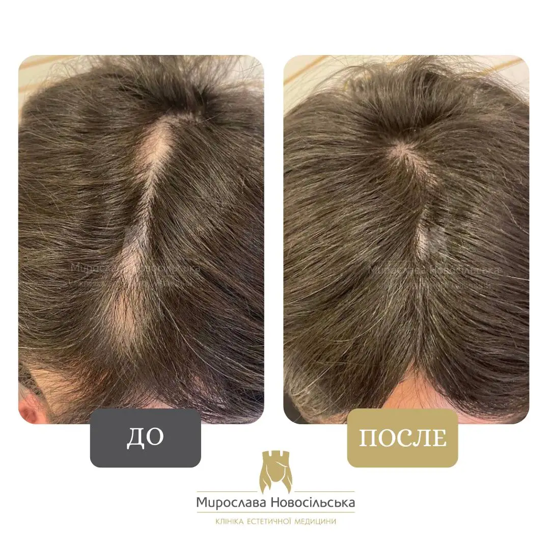 Лечение алопеции у женщин, фото 5