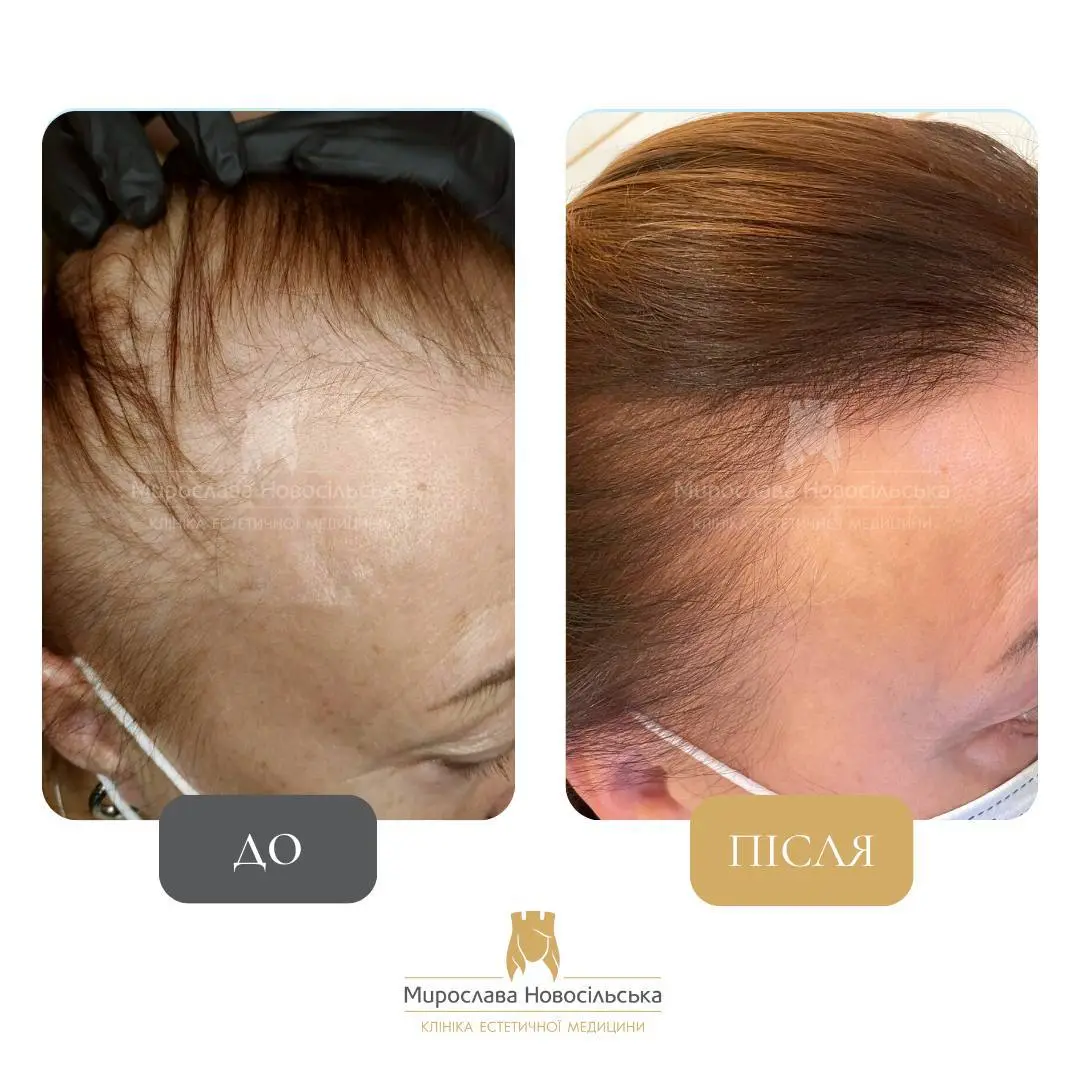 Лікування алопеції, фото 16