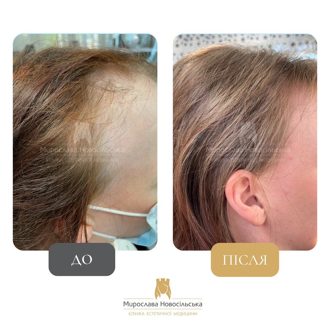 Лікування алопеції, фото 8