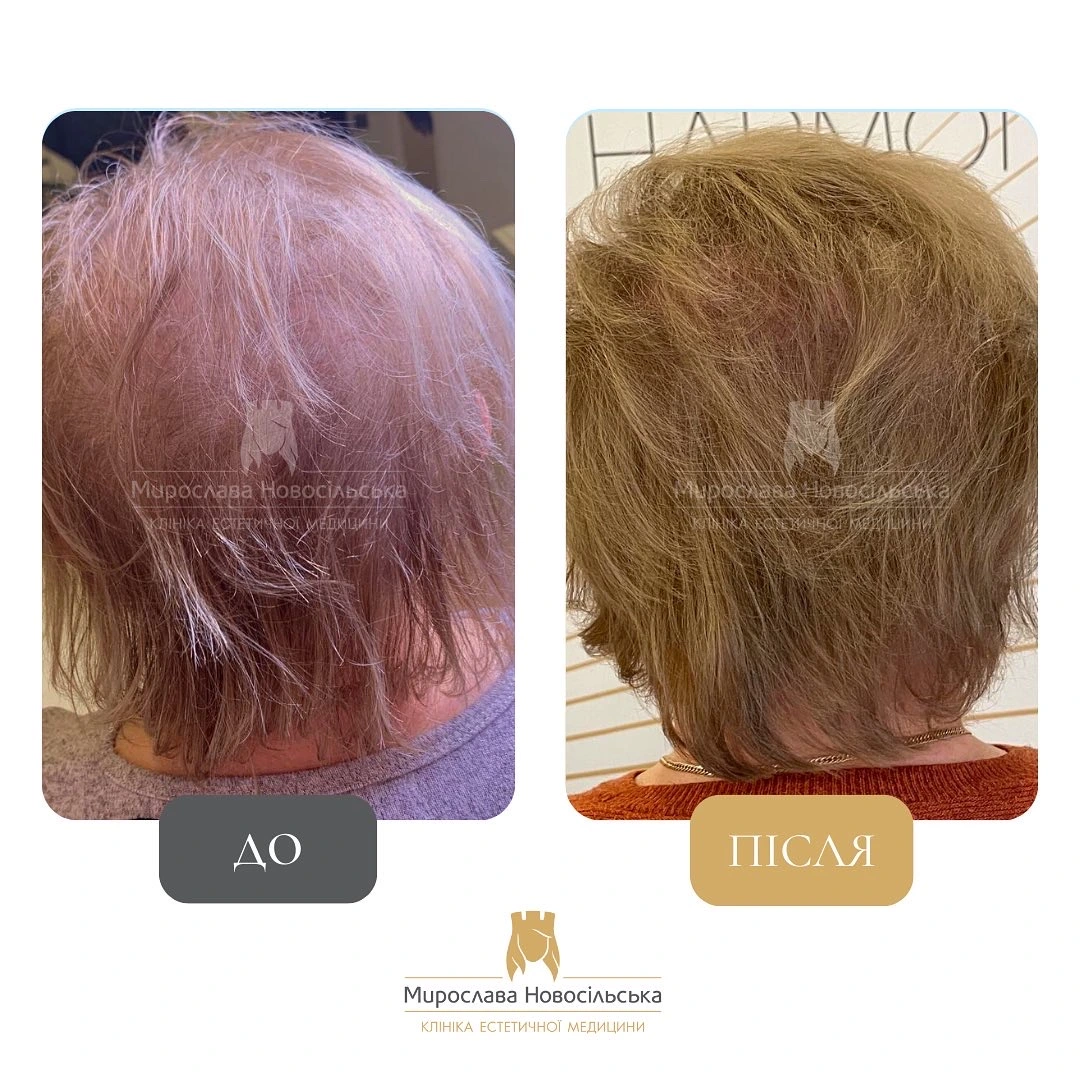 Лікування алопеції, фото 17