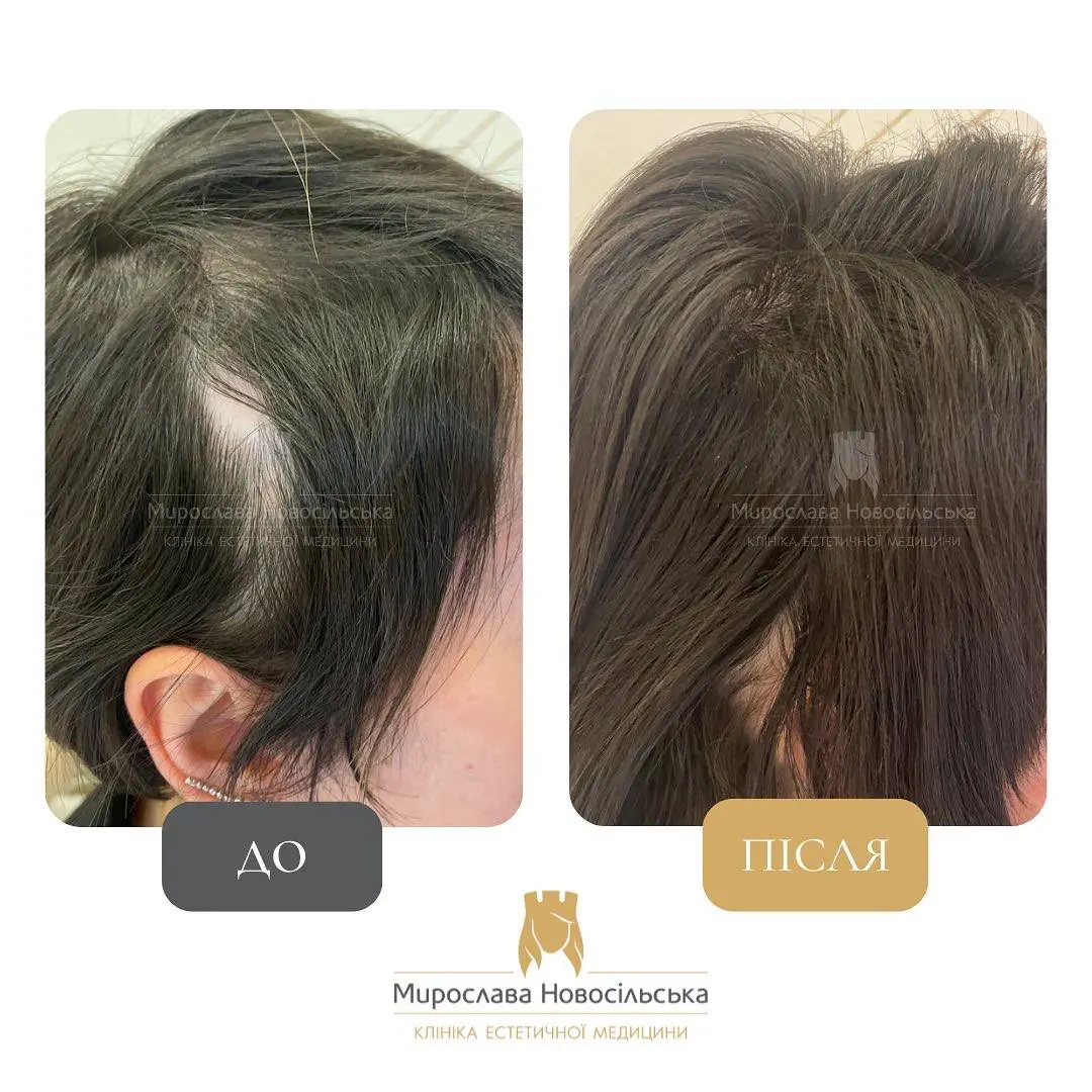 Лікування алопеції, фото 15