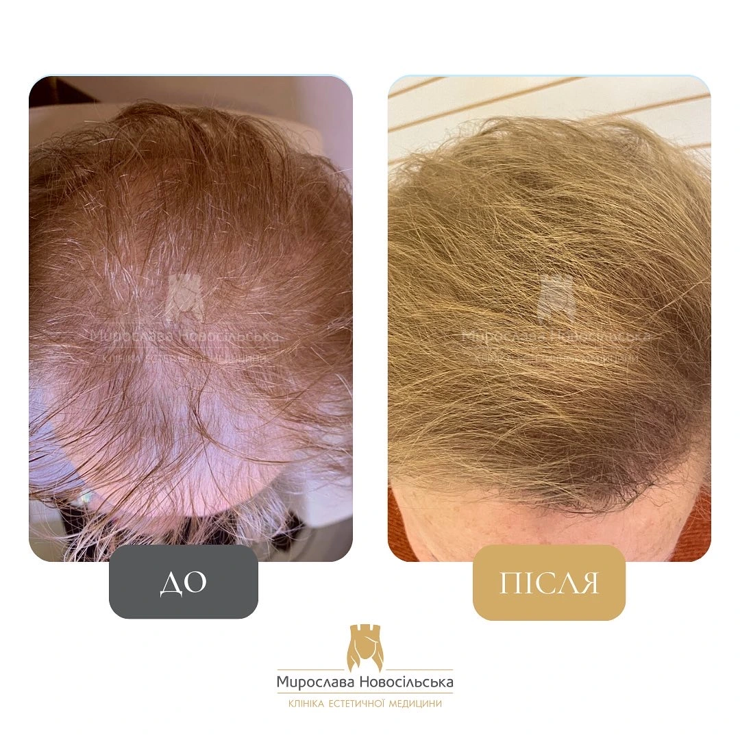 Лікування алопеції, фото 14