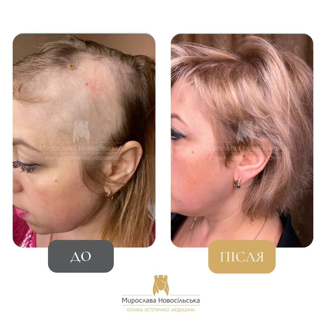 Лікування алопеції, фото 13