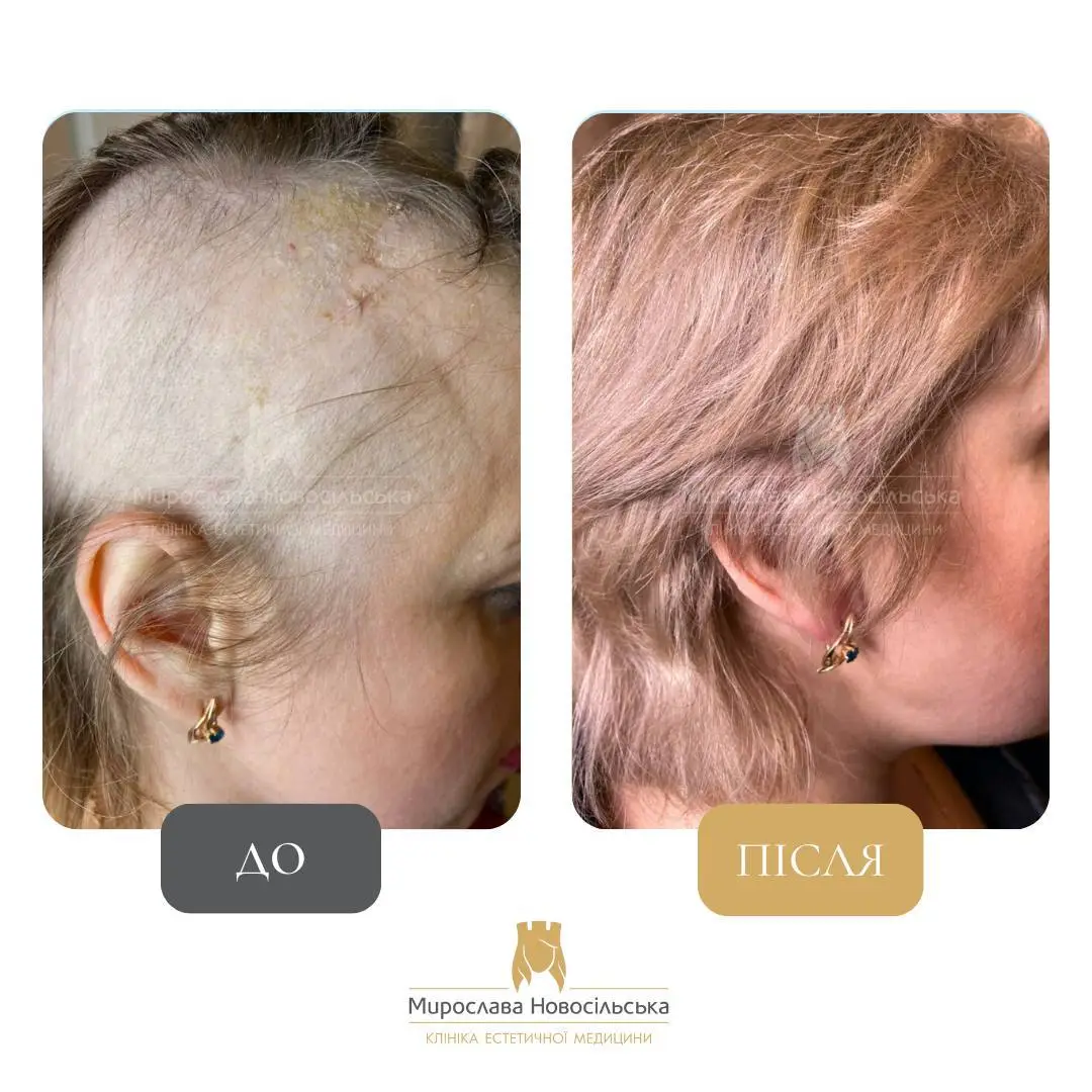 Лікування алопеції, фото 12