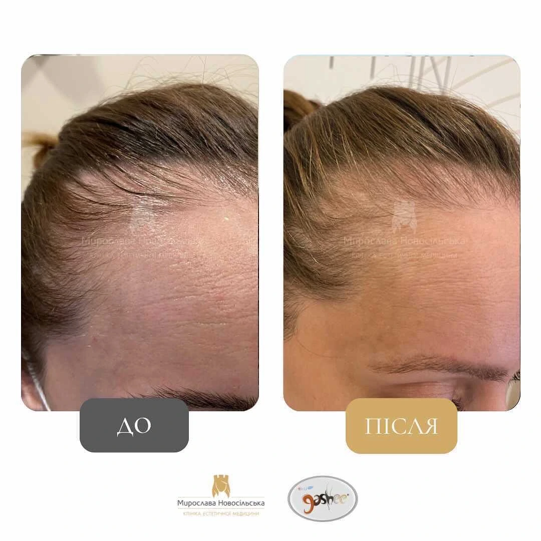 Лікування алопеції, фото 11