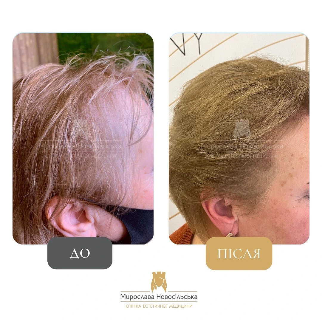 Лікування алопеції, фото 9