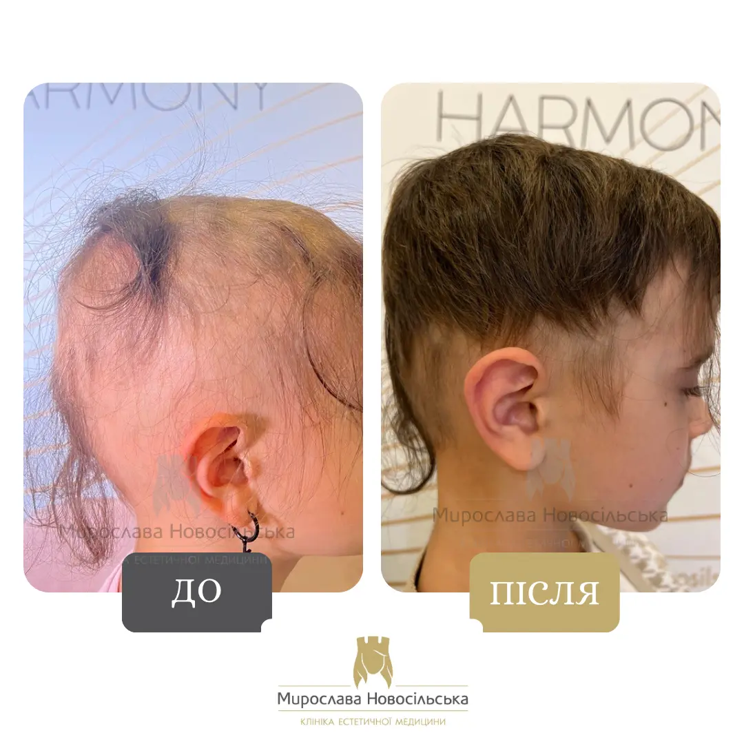 Лікування алопеції, фото 5