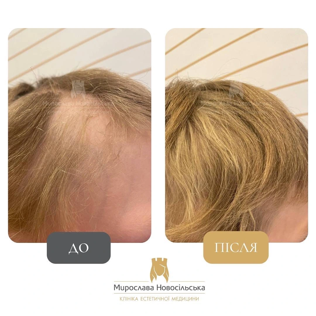 Лікування алопеції, фото 3