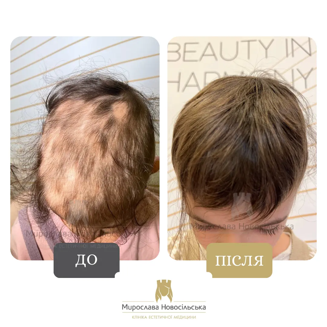 Лікування алопеції, фото 4
