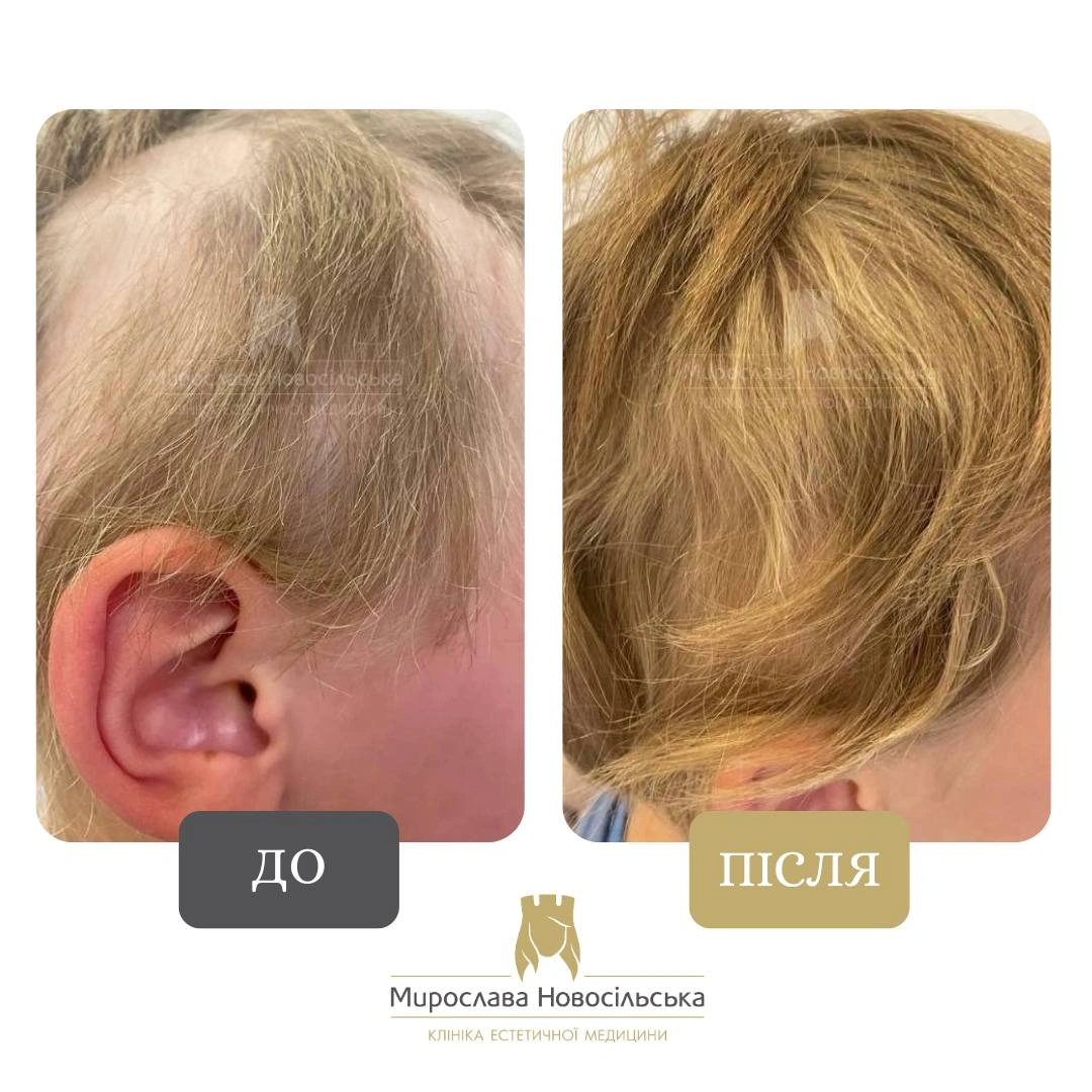 Лікування алопеції, фото 6