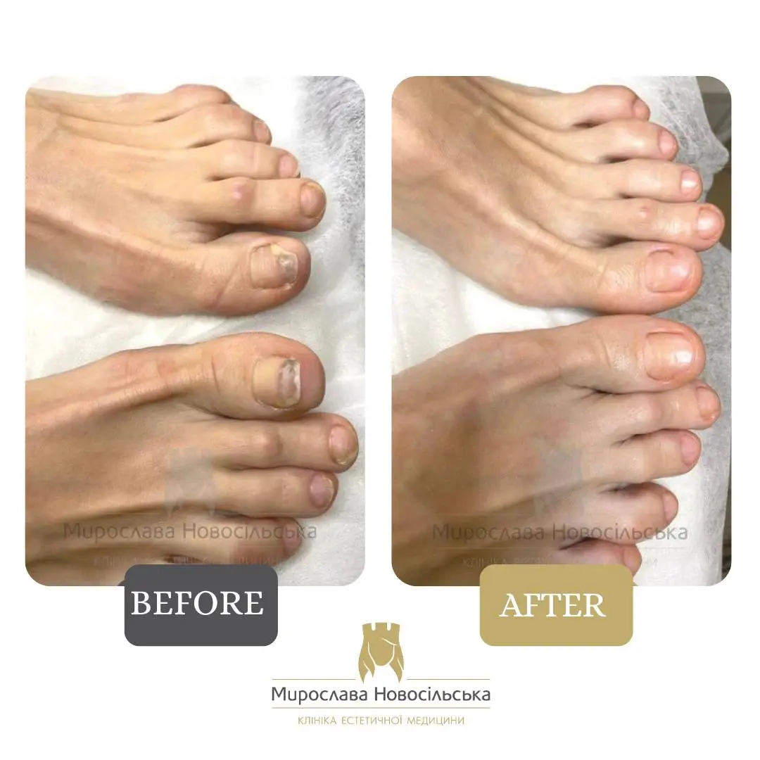 Treatment of onycholysis, photo 2