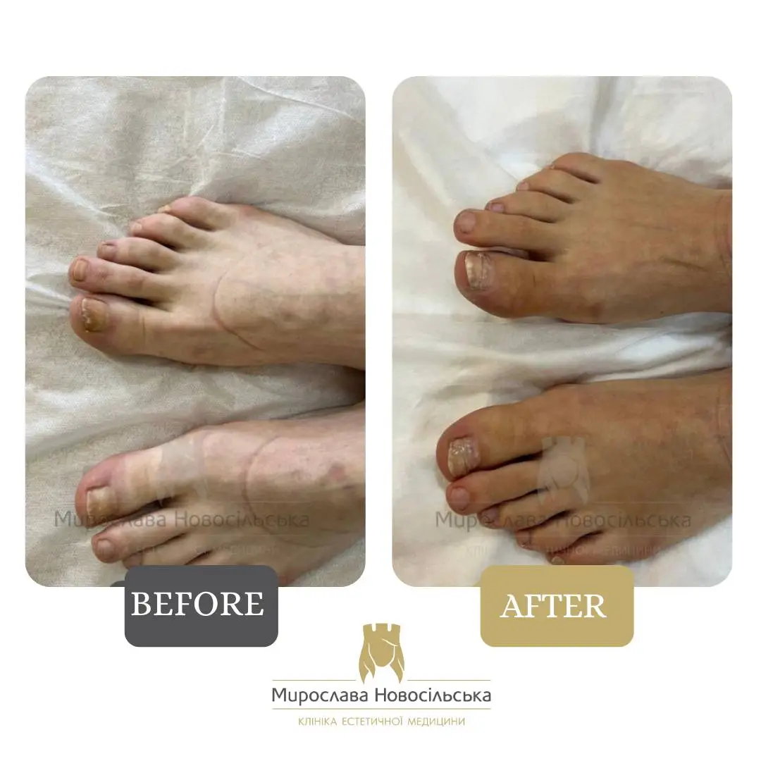 Treatment of onycholysis, photo 3