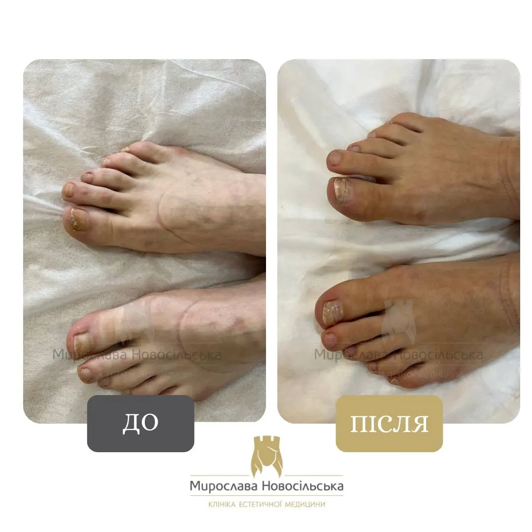 Лікування оніхолізису, фото 3