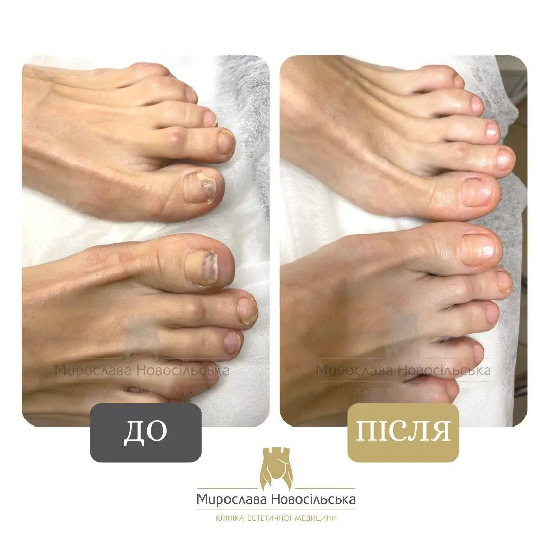 Лікування оніхолізису, фото 2