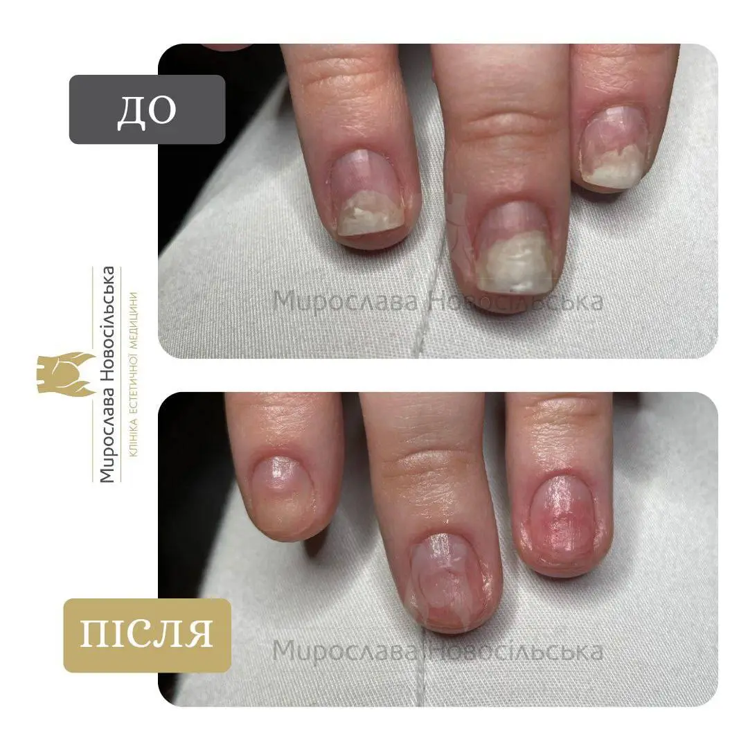 Лікування оніхолізису, фото 5