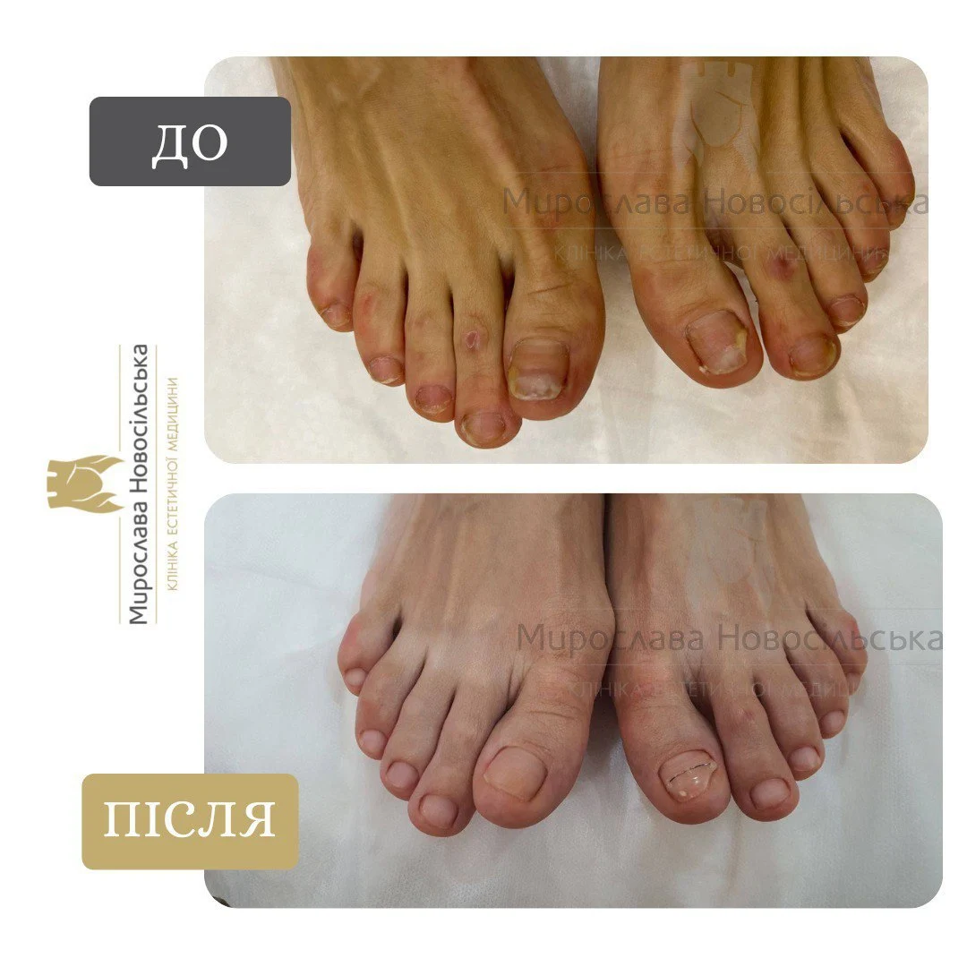 Лікування оніхолізису, фото 4