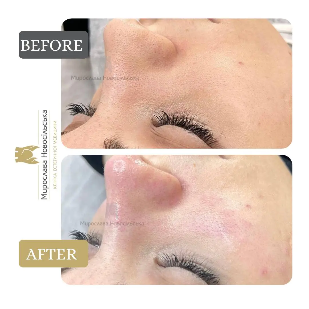 Facial cleansing, photo 2