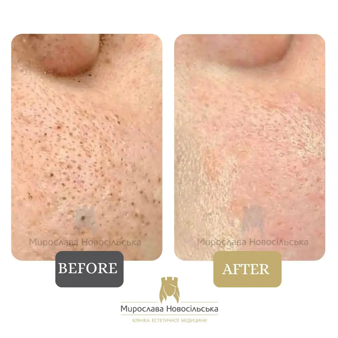 Facial cleansing, photo 3