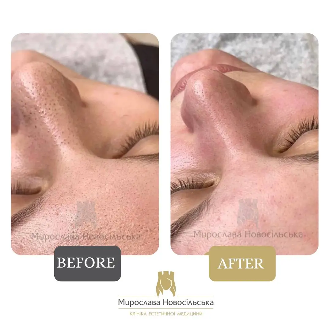 Facial cleansing, photo 4