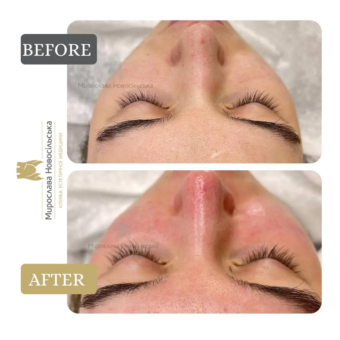 Facial cleansing, photo 5