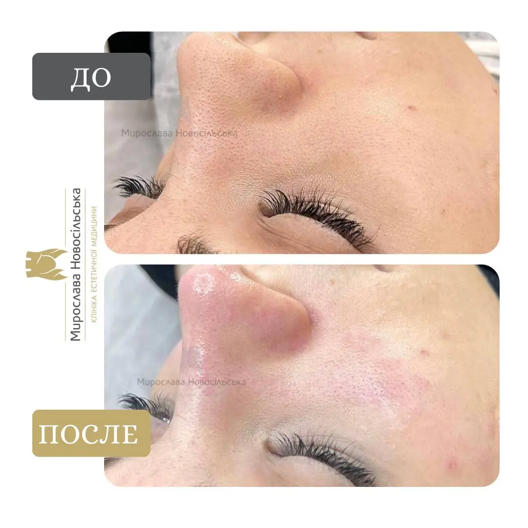 Механическая чистка лица, фото 2