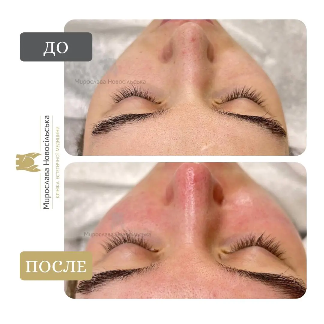 Механическая чистка лица, фото 5