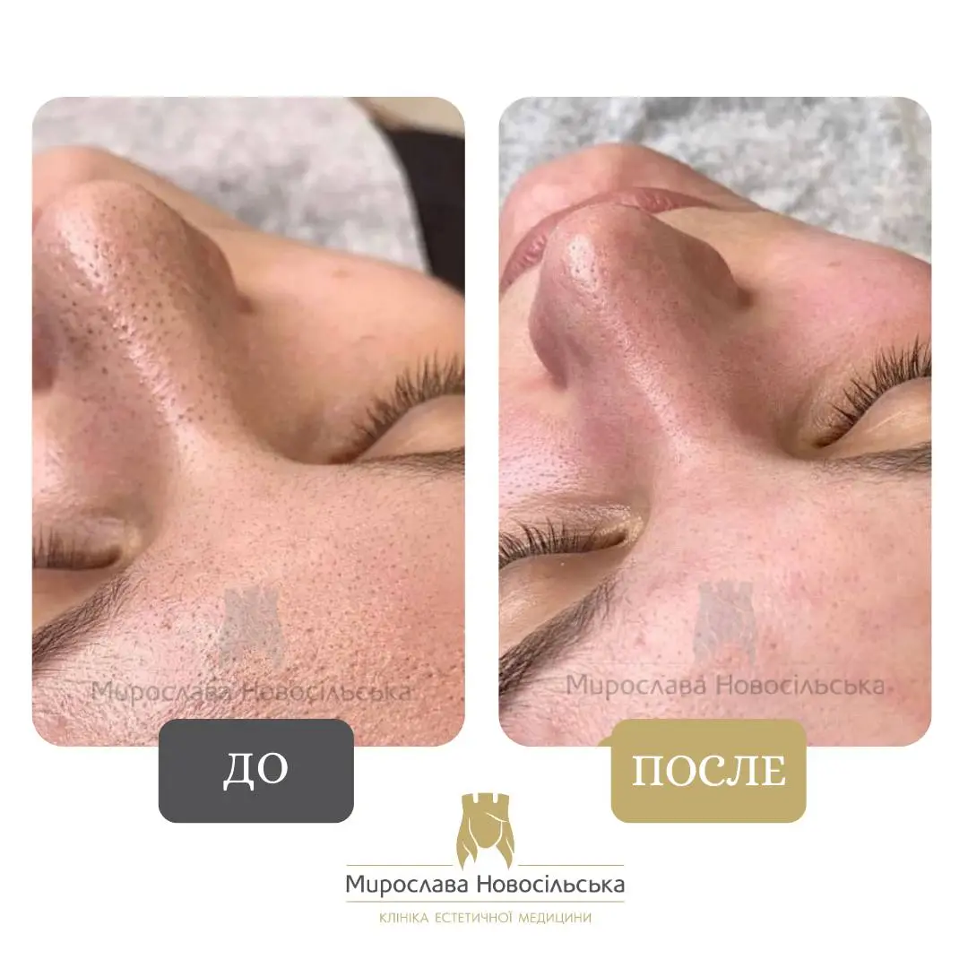 Механическая чистка лица, фото 4