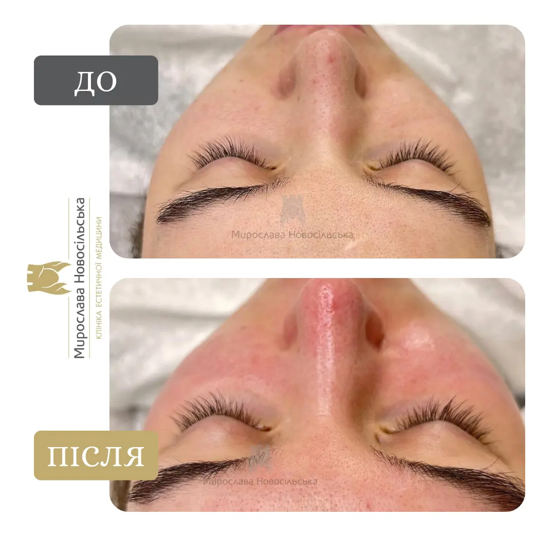 Механічна чистка обличчя, фото 5