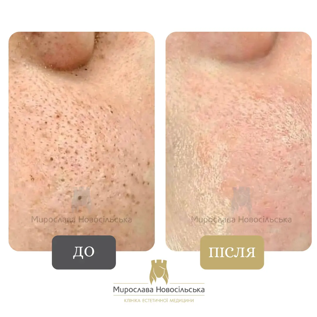 Механічна чистка обличчя, фото 3