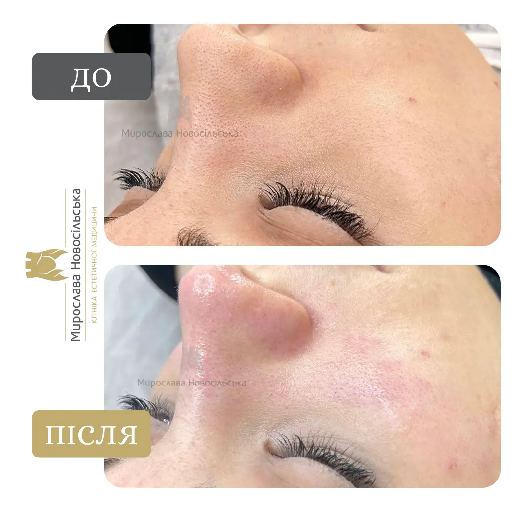 Механічна чистка обличчя, фото 2