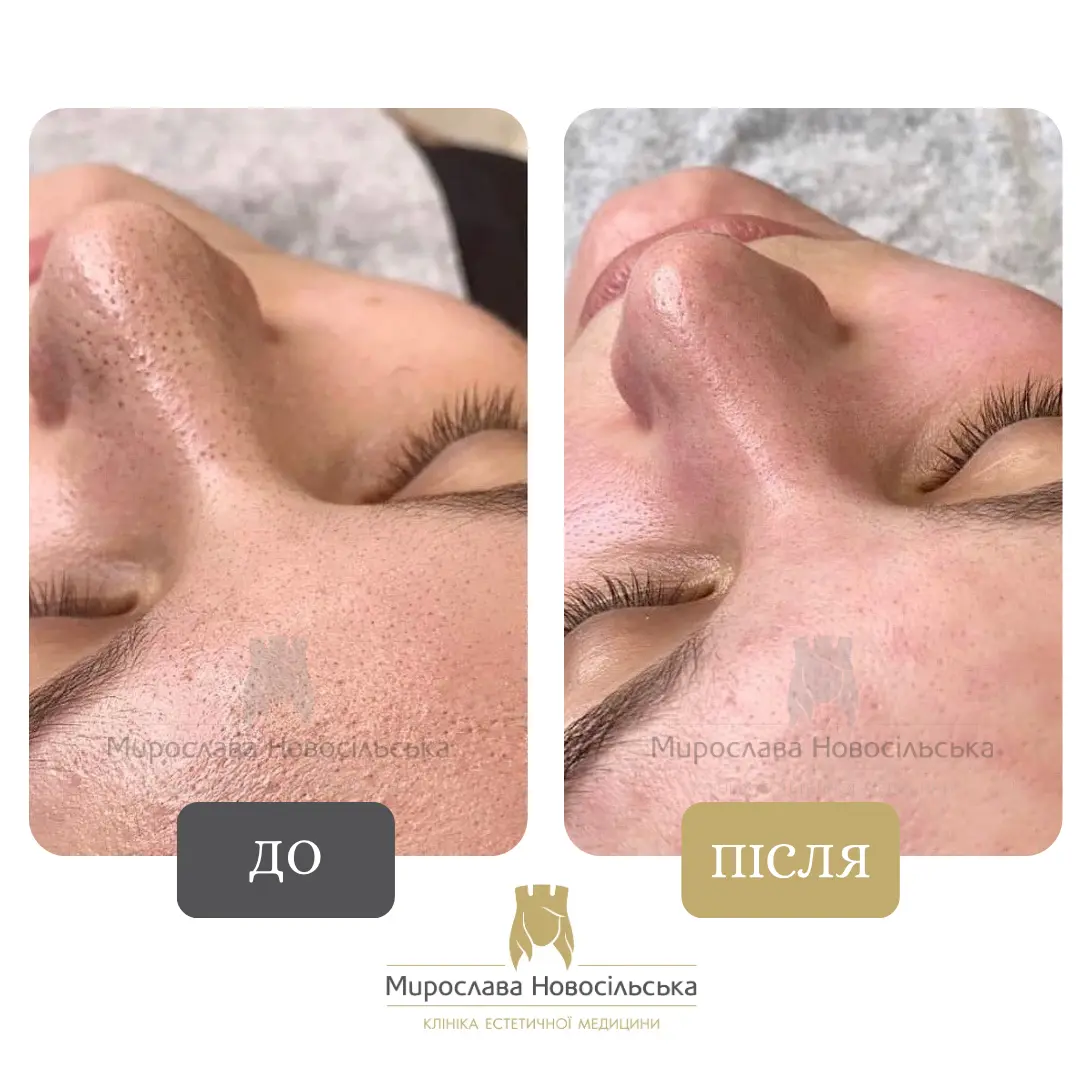 Механічна чистка обличчя, фото 4