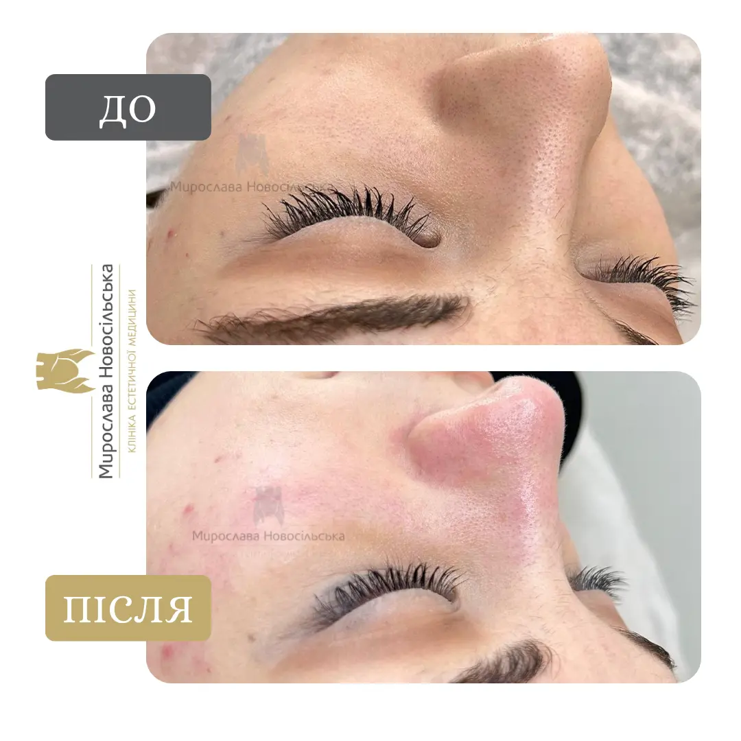 Механічна чистка обличчя, фото 6