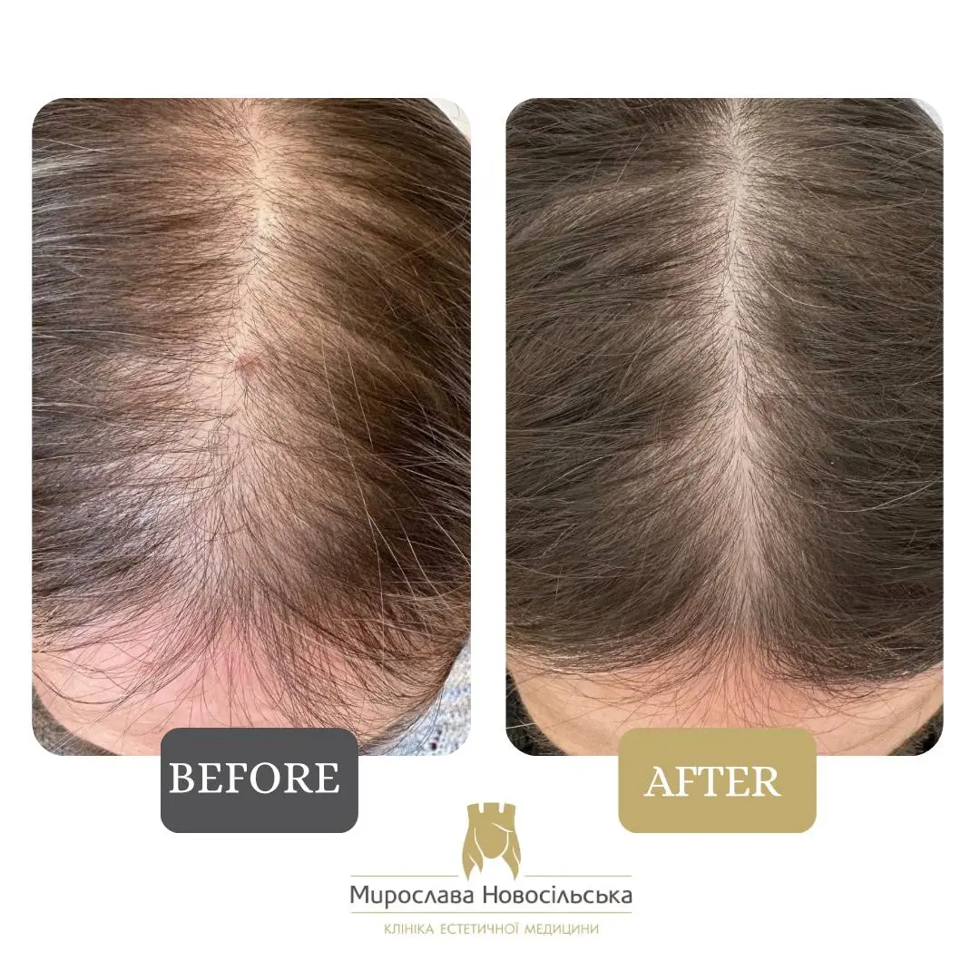 Scalp mesotherapy, photo 4