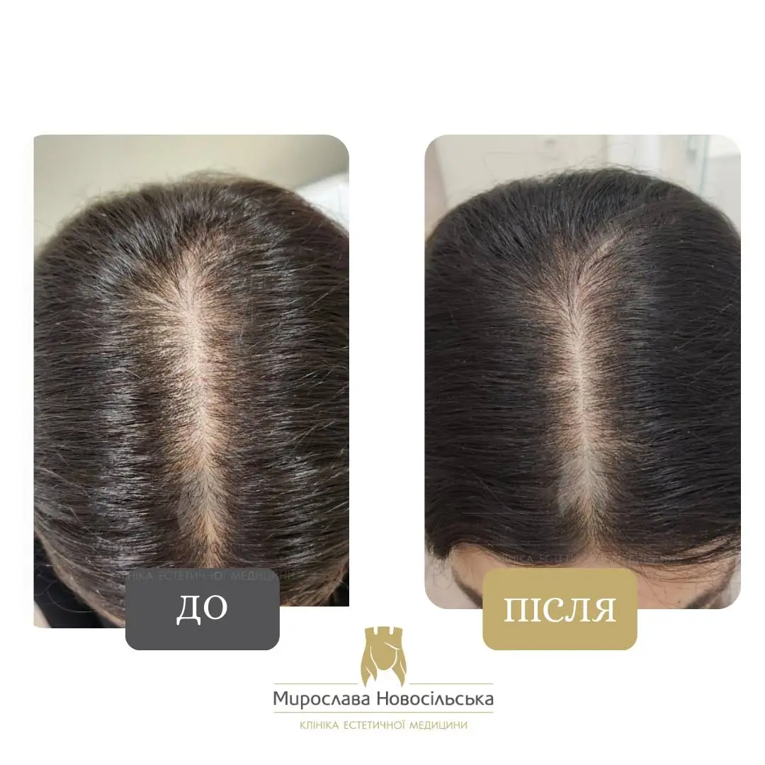 Мезотерапія шкіри голови, фото 4