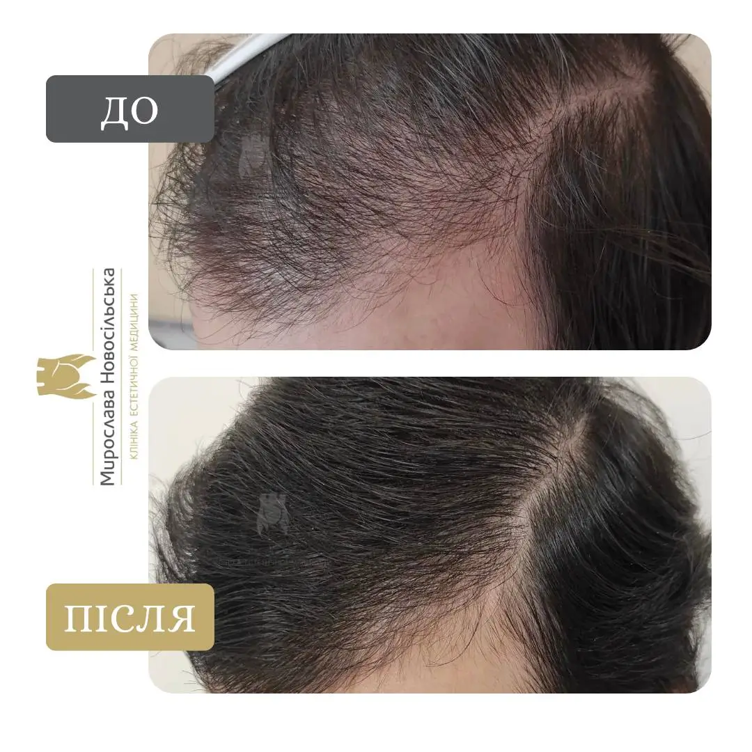 Мезотерапія шкіри голови, фото 2