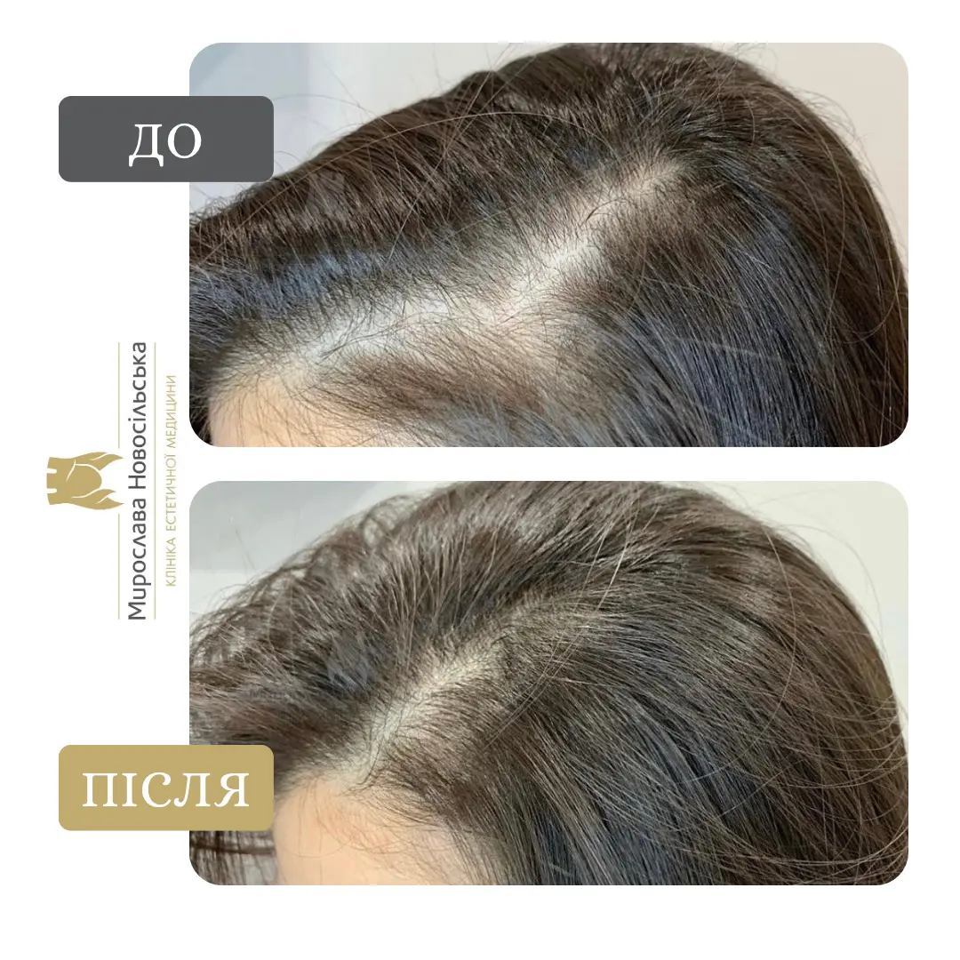 Мезотерапія шкіри голови, фото 5