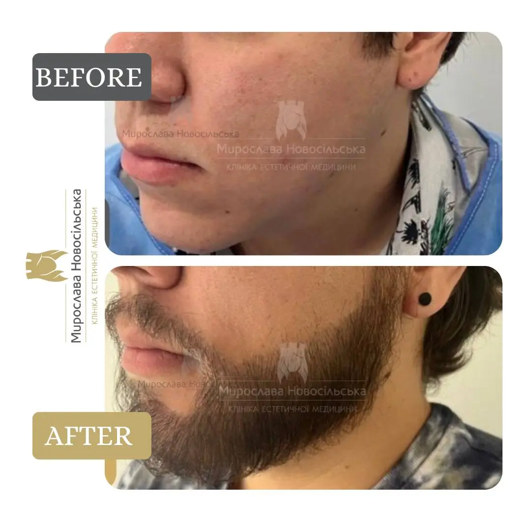 Beard transplant, photo 2