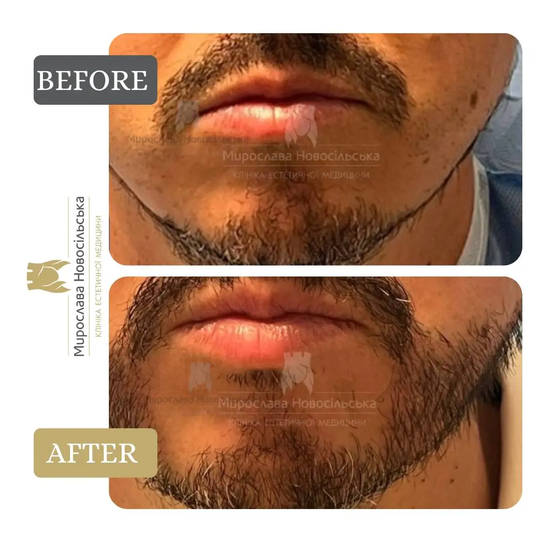 Beard transplant, photo 3