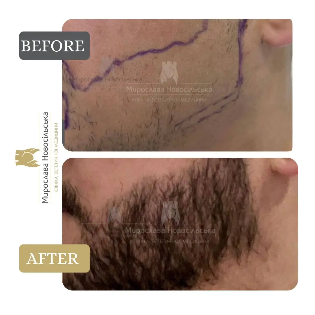 Beard transplant, photo 4