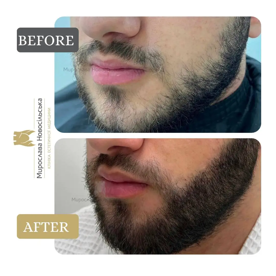 Beard transplant, photo 5