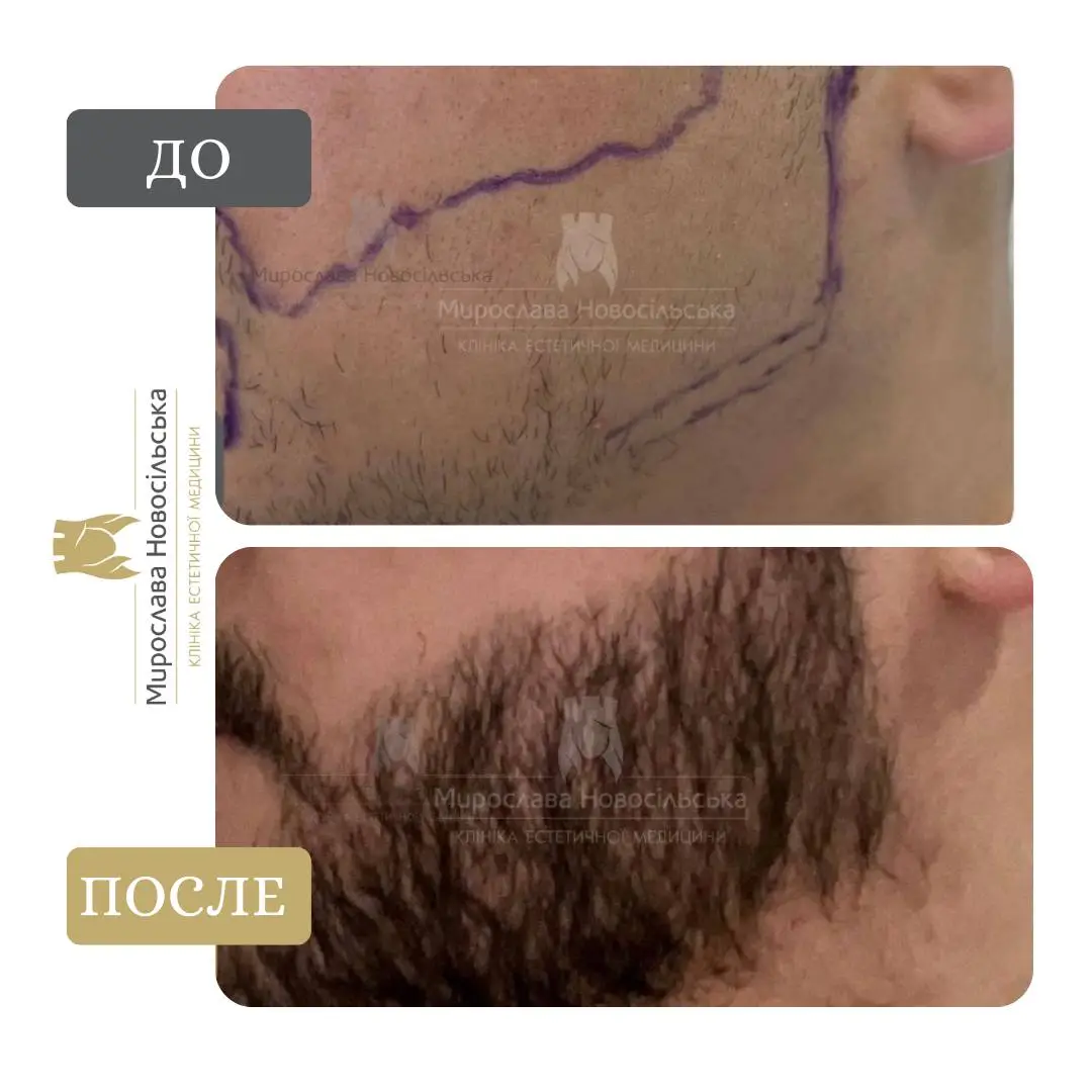 Пересадка бороды, фото 4