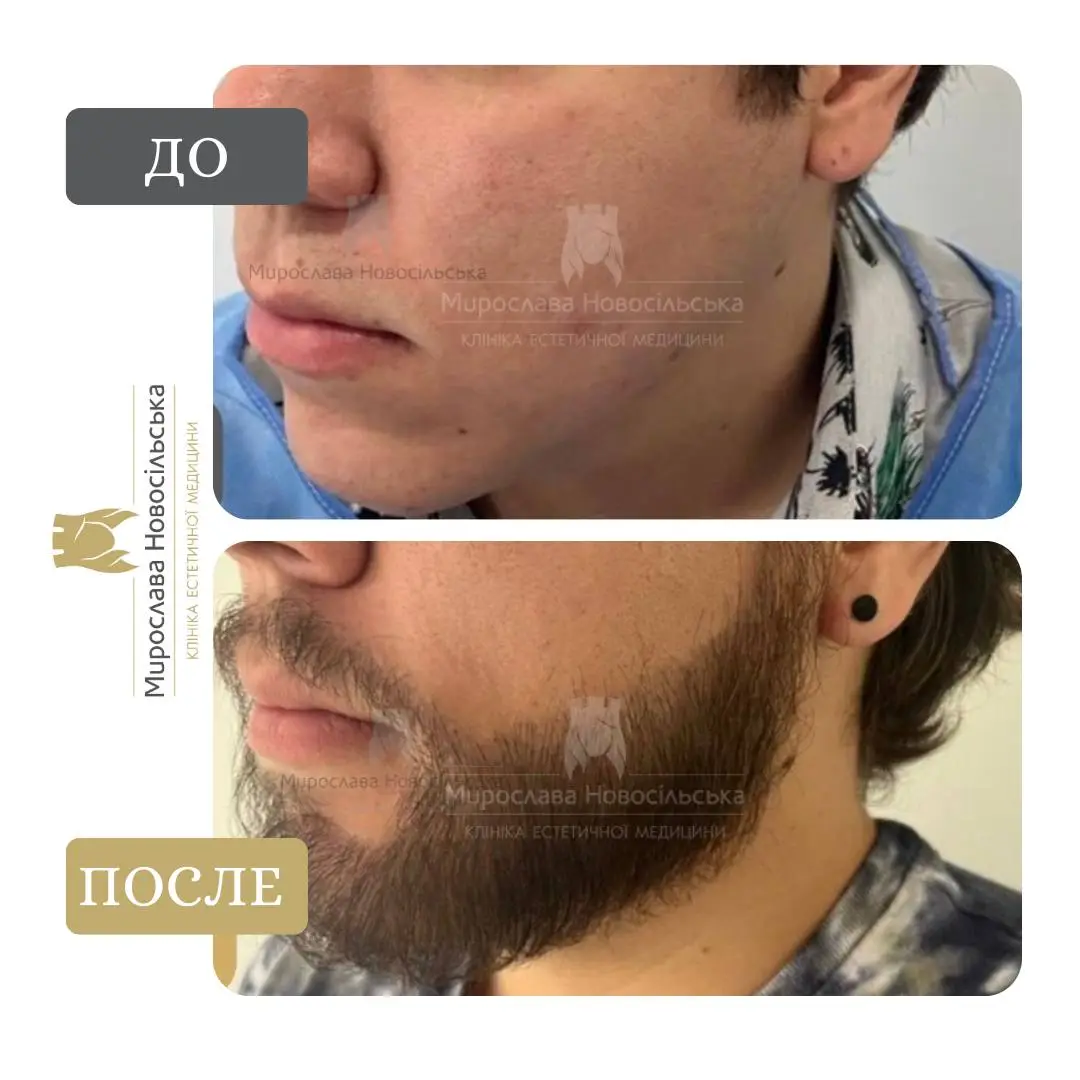 Пересадка бороды, фото 2