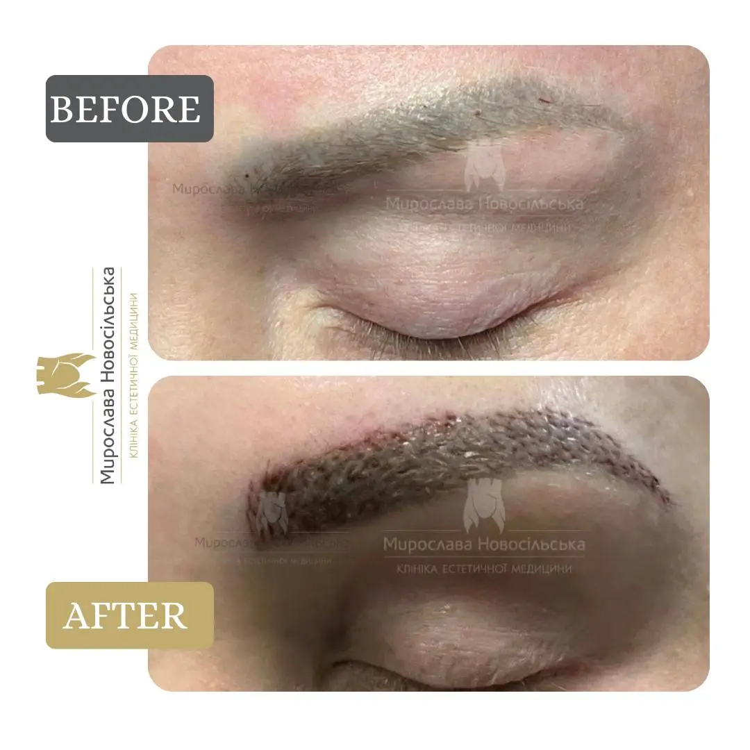 Eyebrow transplant, photo 2