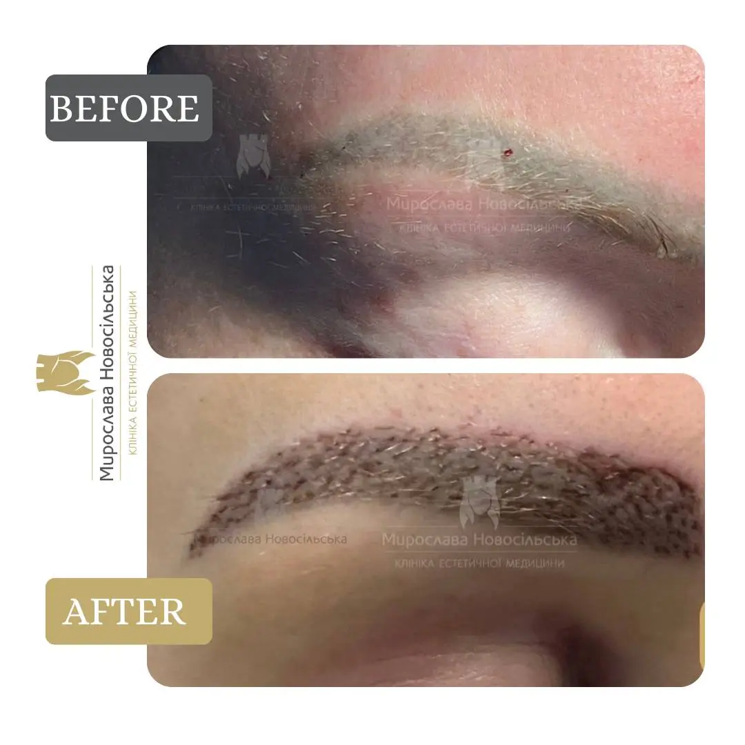 Eyebrow transplant, photo 3