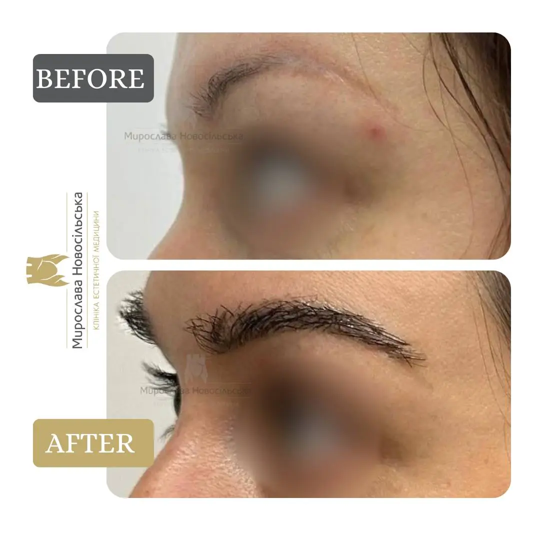 Eyebrow transplant, photo 5