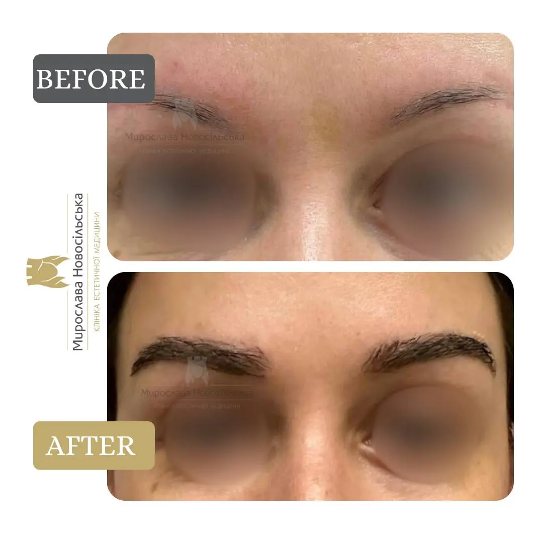 Eyebrow transplant, photo 6