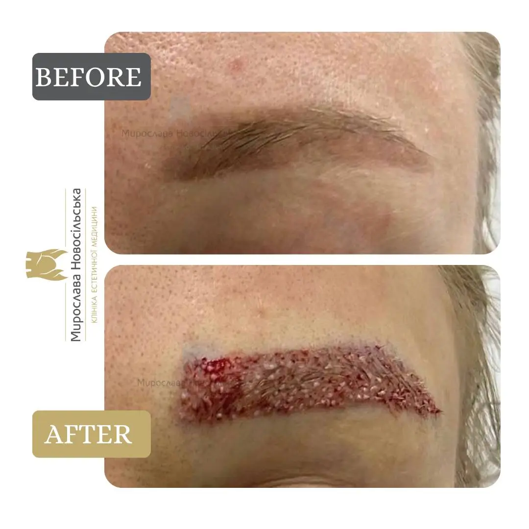 Eyebrow transplant, photo 4